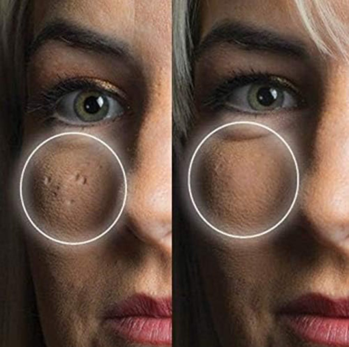 Corrector para cicatrices
