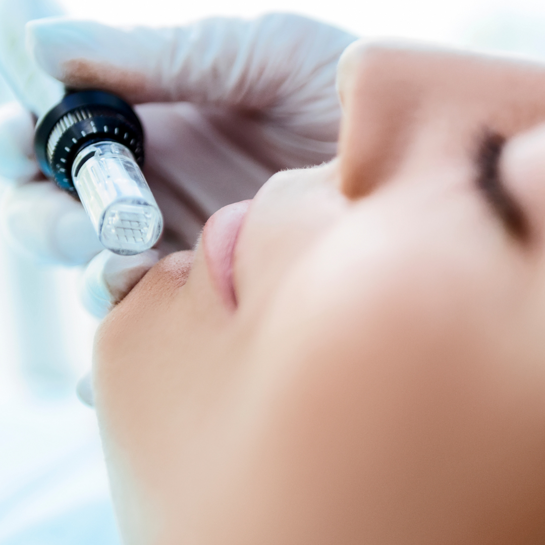 Dermapen de Labios
