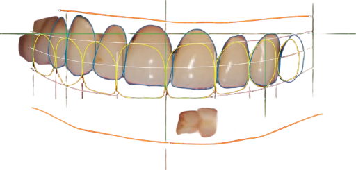 Wax up numérique  /u