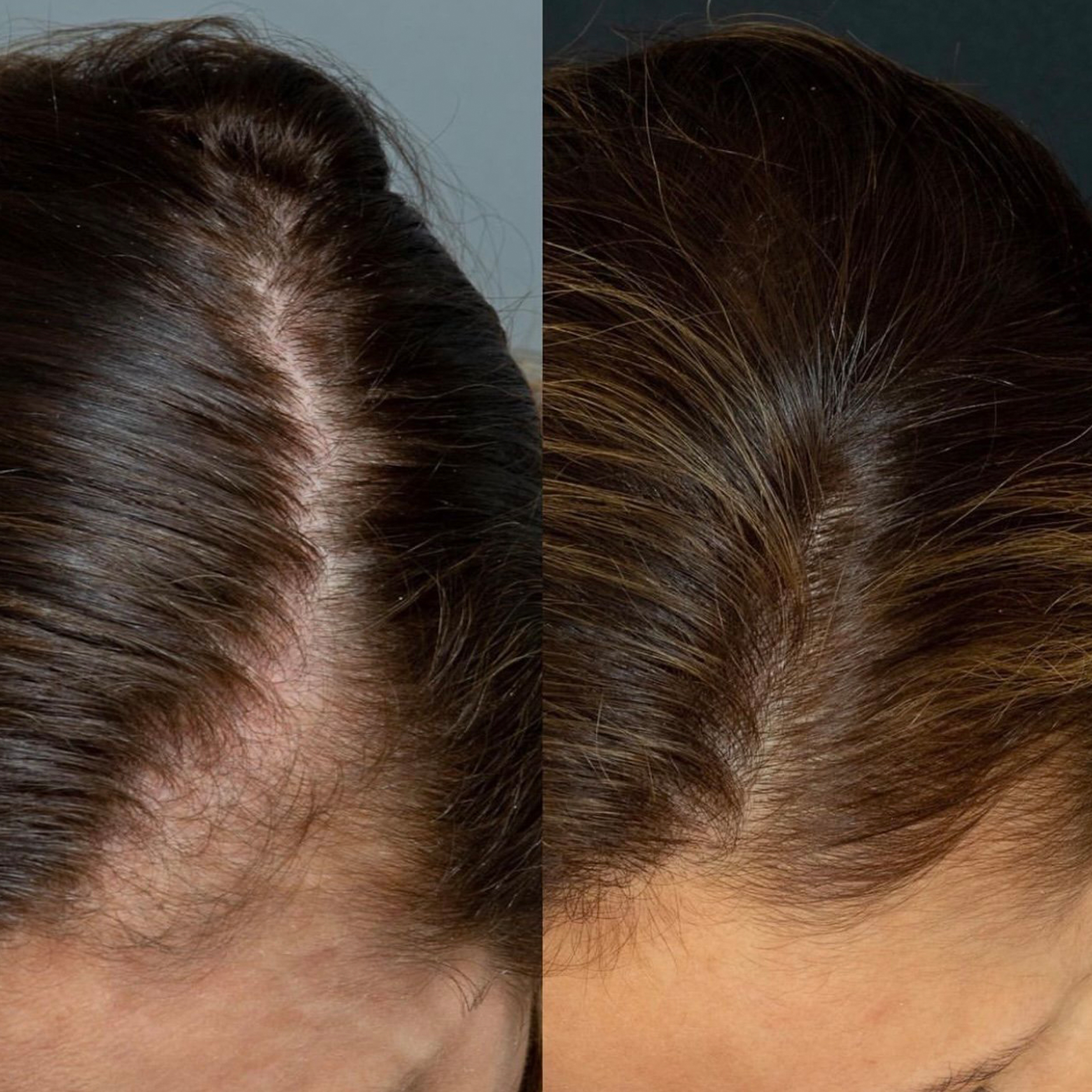 PRP Hair Restoration