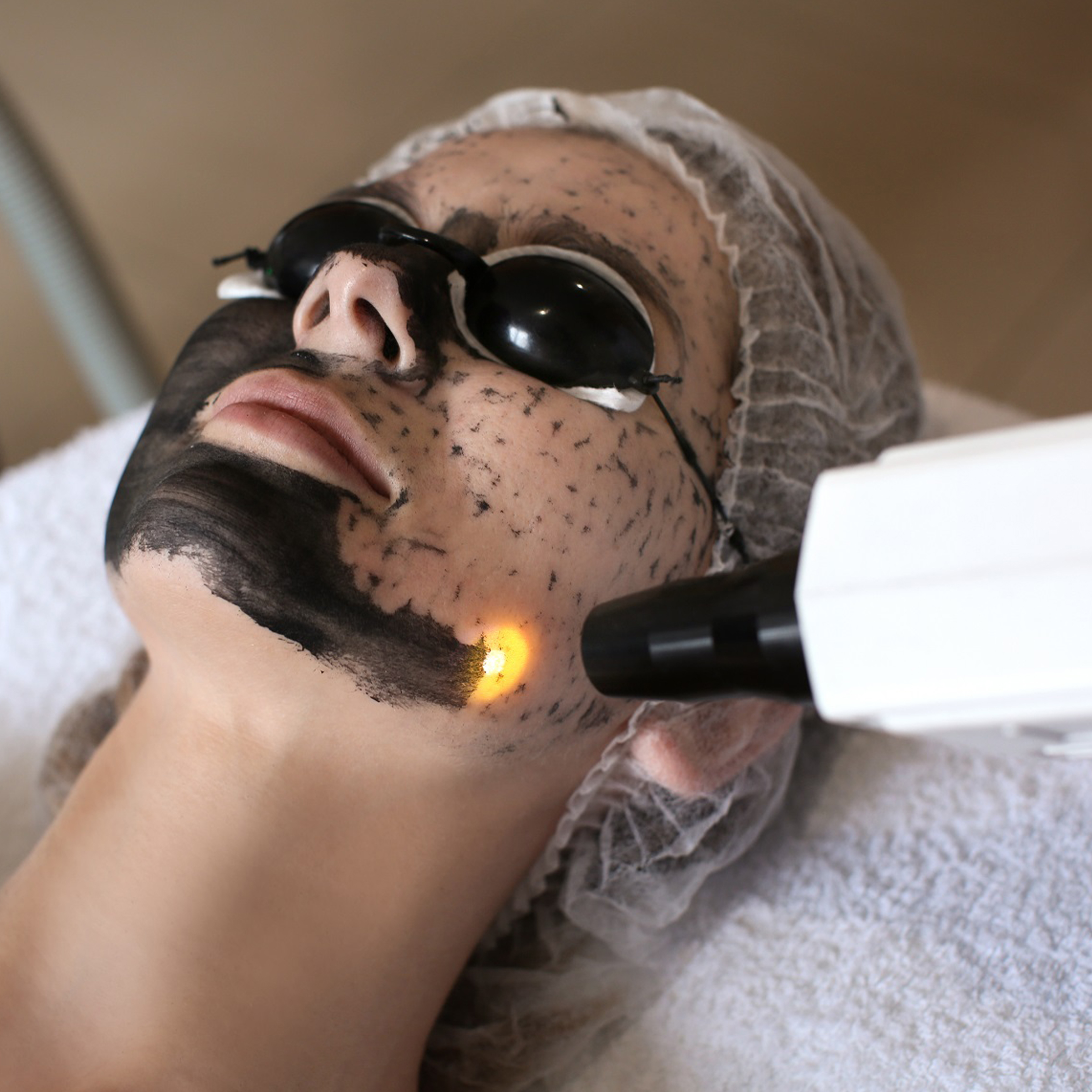 Carbon Laser Facial