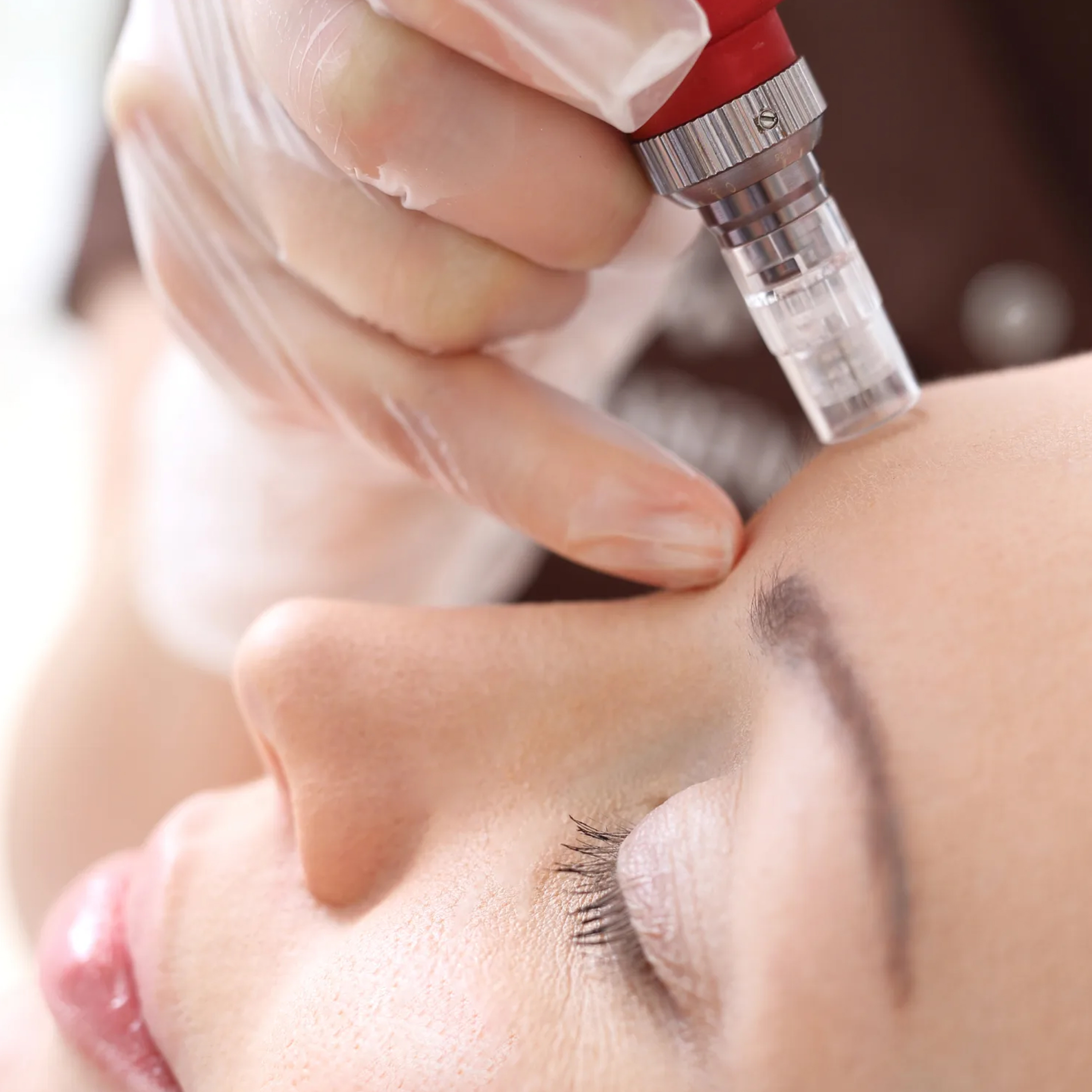 Micro-Needling