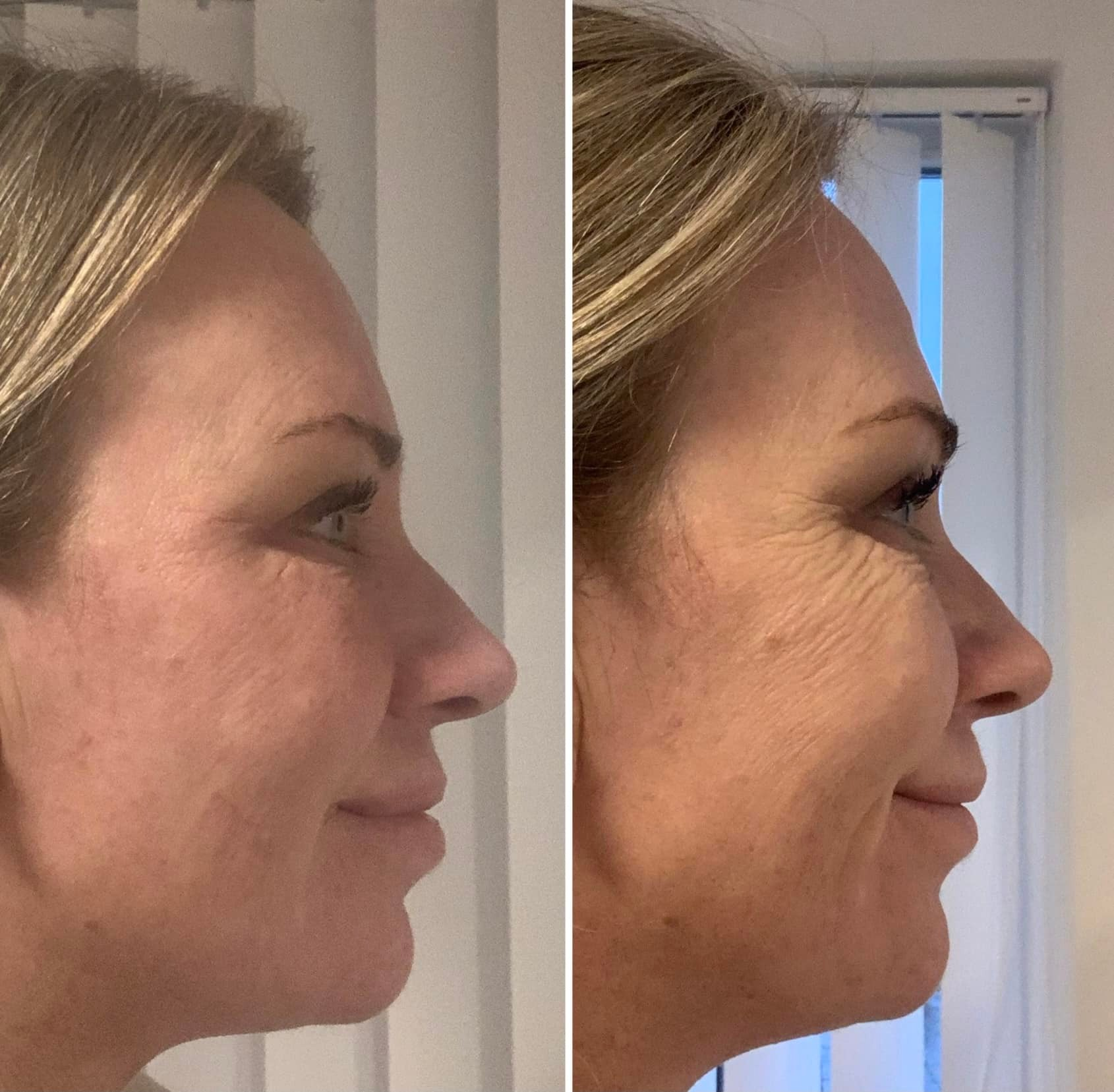 HIFU Face & Body Treatment