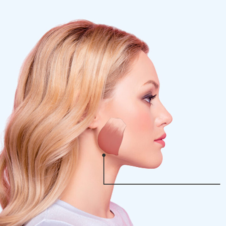Masseter Botox