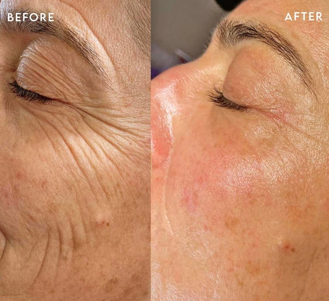 HIFU Face & Body Treatment