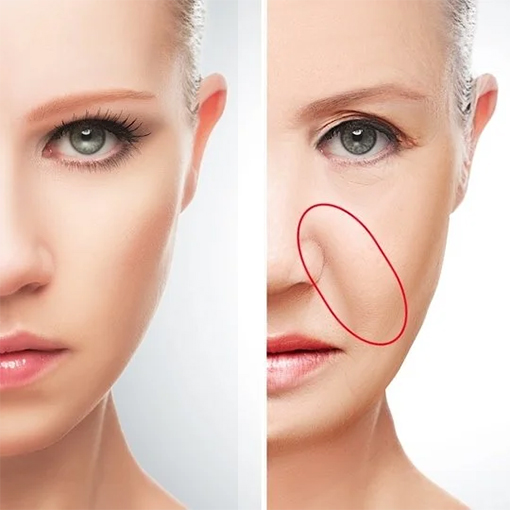 Nasolabial Fold Filler