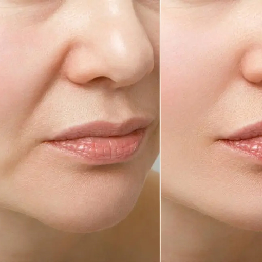 Marionette Lines Filler