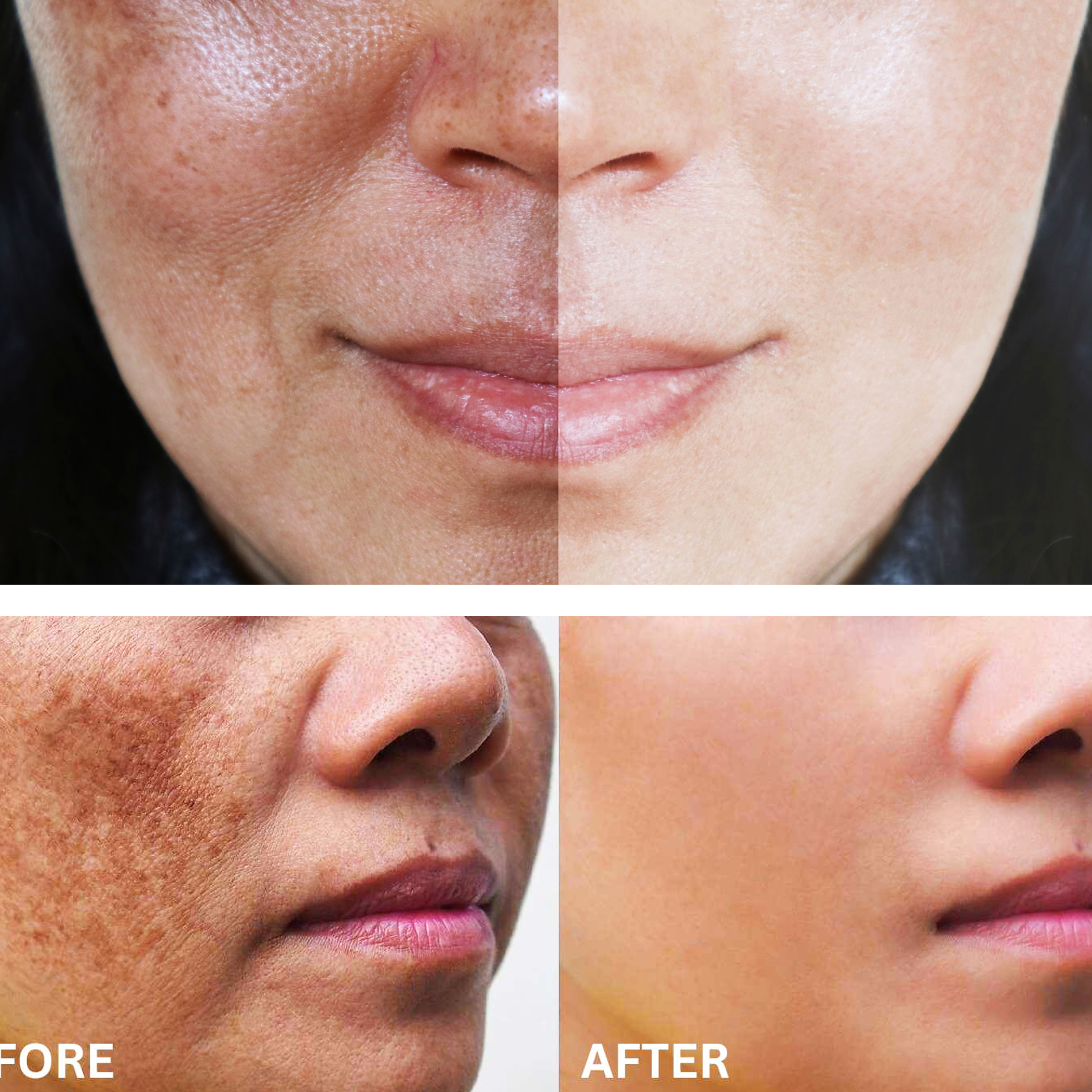 Q-Switched Laser Treatment