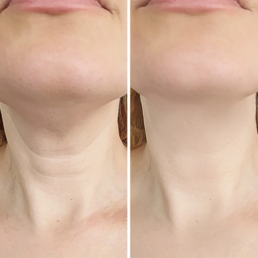 Platysmal Bands Dysport