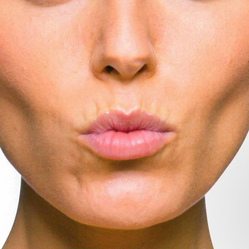 Peri Oral Lines Dysport