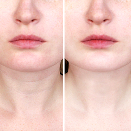 Nefertiti Neck Lift Botox