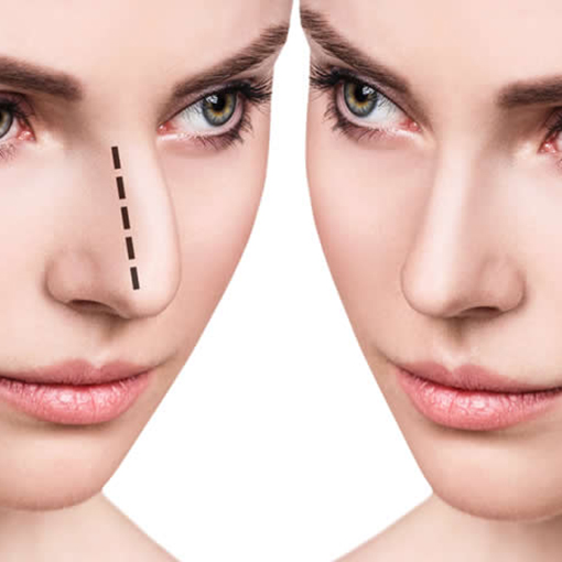 Non-surgical Rhinoplasty Filler