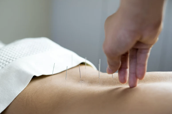 Acupuncture 