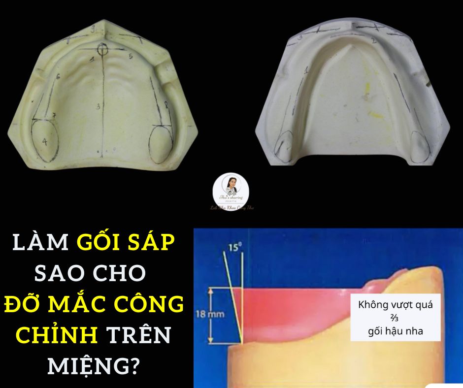 Các đường chuẩn đặt cung gối sáp cho toàn hàm