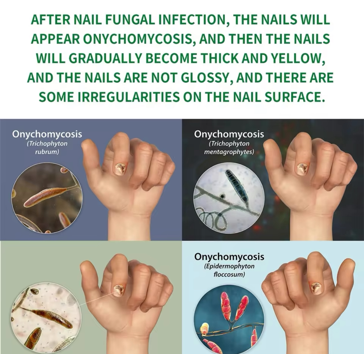7 Days Nail Fungus Treatment Serum
