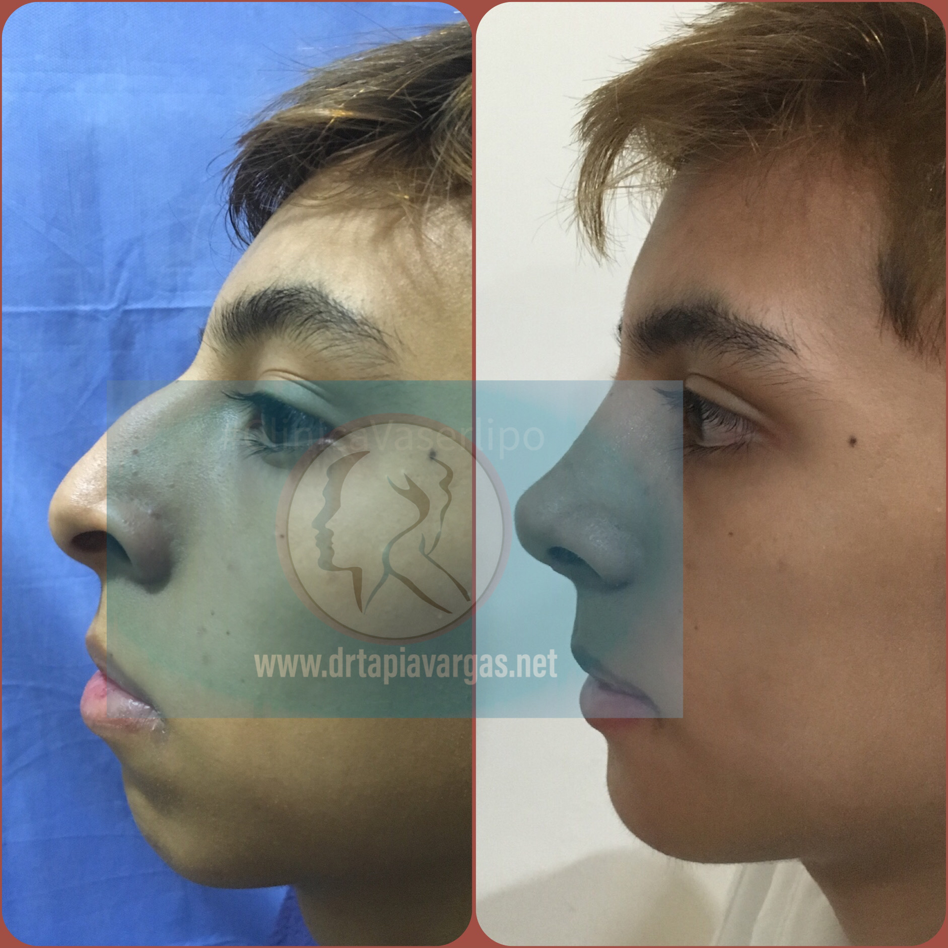 FACIAL HARMONIZATION 