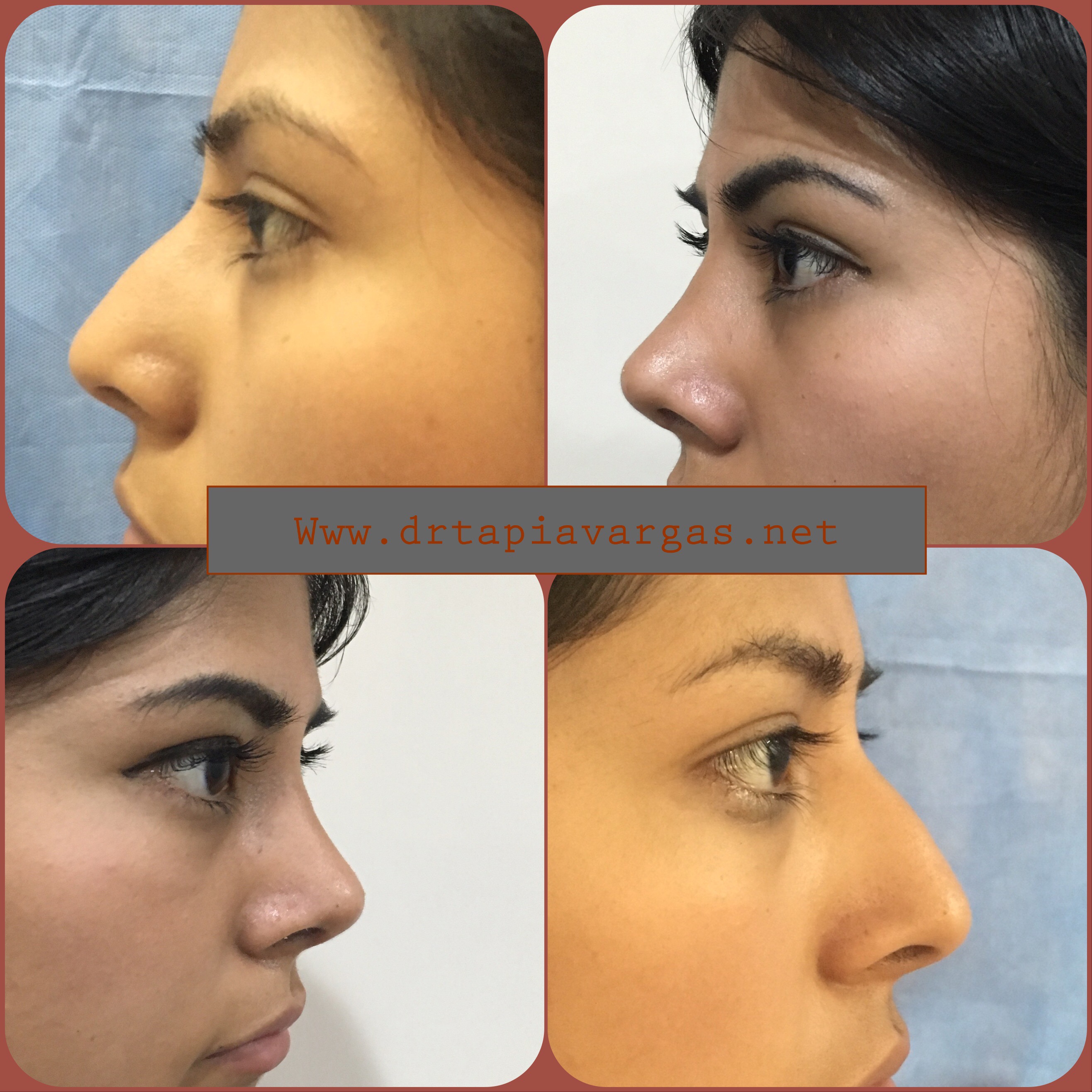 FACIAL HARMONIZATION 