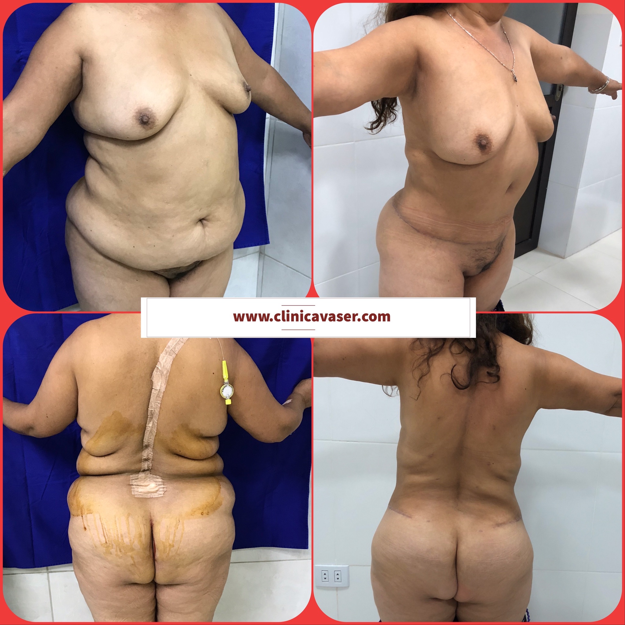 Servicio de Remodelación Corporal