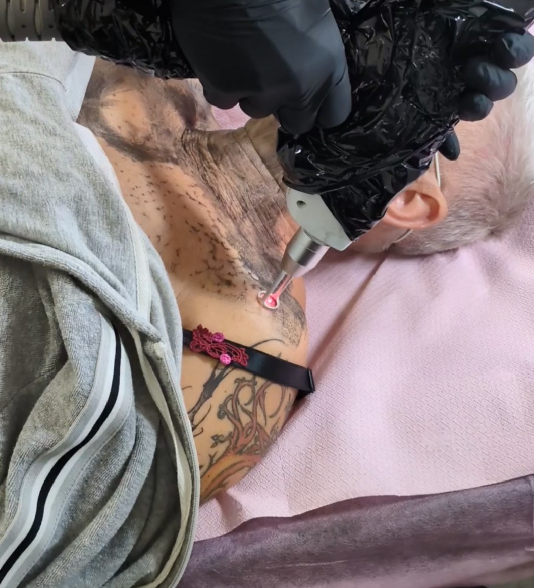 Sesja peeling węglowy twarzy, szyi i dekoltu (REZERWACJA BEZPŁATNA!)