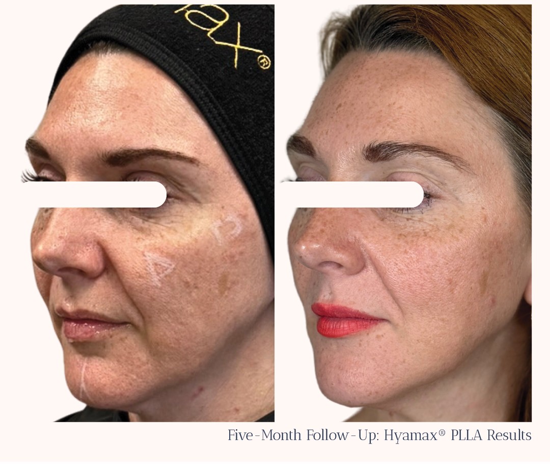 Hyomax PLLA Injectable Poly-L-Lactic Acid Filler