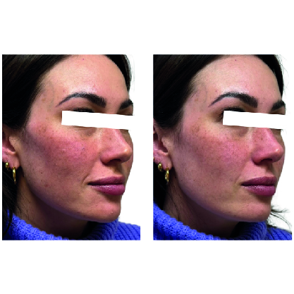 Hyamax CaHA Lido Injectable Facial Implant