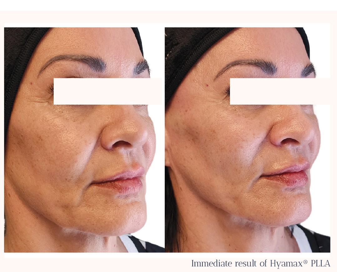 Hyomax PLLA Injectable Poly-L-Lactic Acid Filler