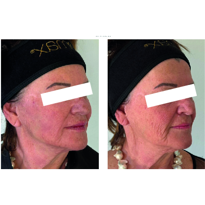 Hyamax CaHA Lido Injectable Facial Implant