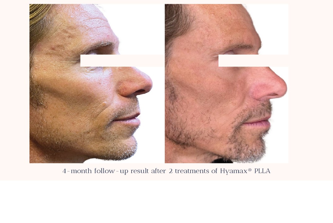 Hyomax PLLA Injectable Poly-L-Lactic Acid Filler