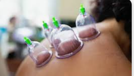Therapeutic Cupping