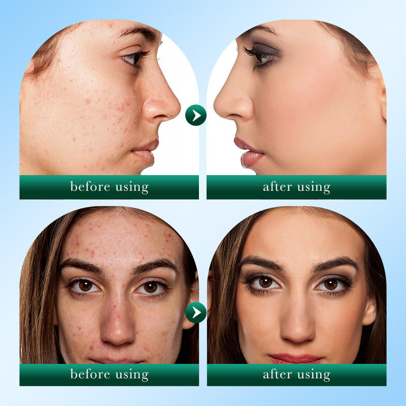 Tea Tree Acnes Oil Control Cleanser