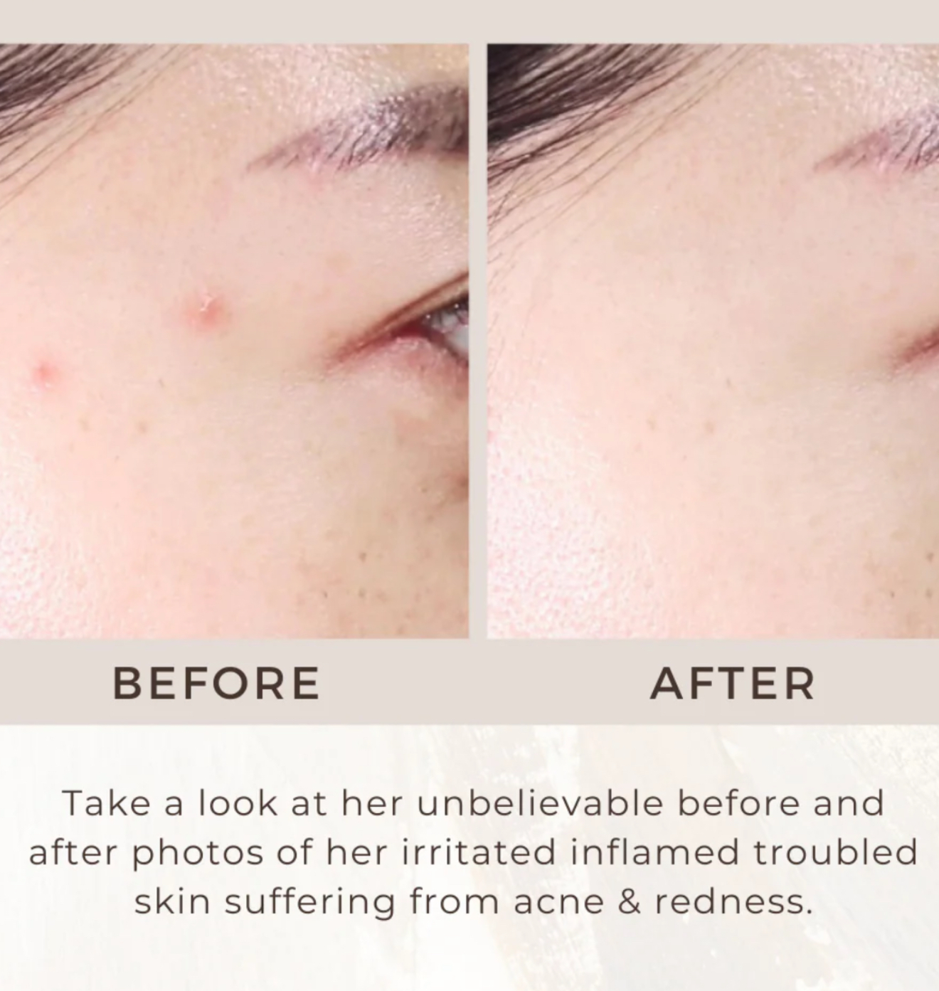 Acne Gel
