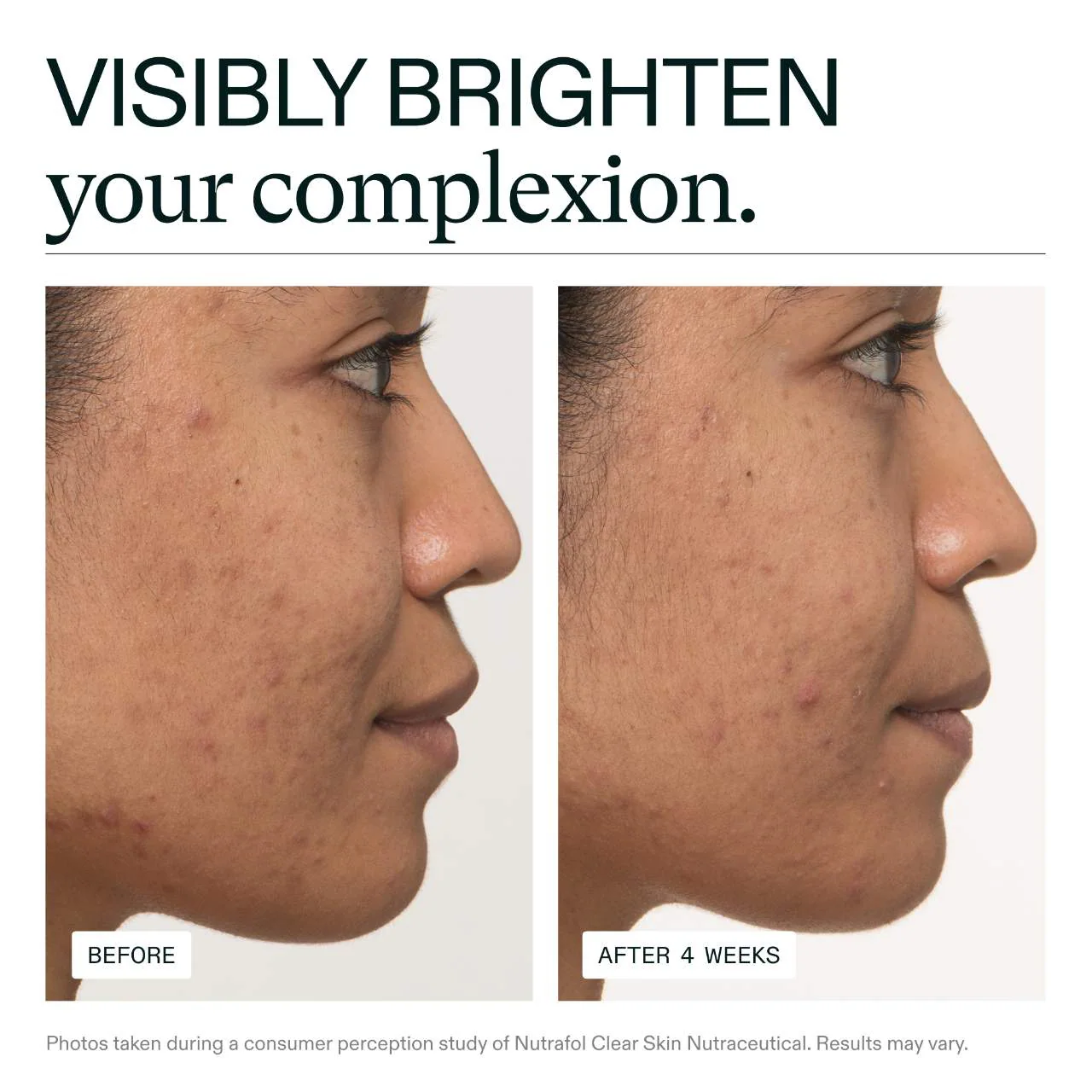 Clear Skin Physician-formulated Supplement for Acne and Breakouts