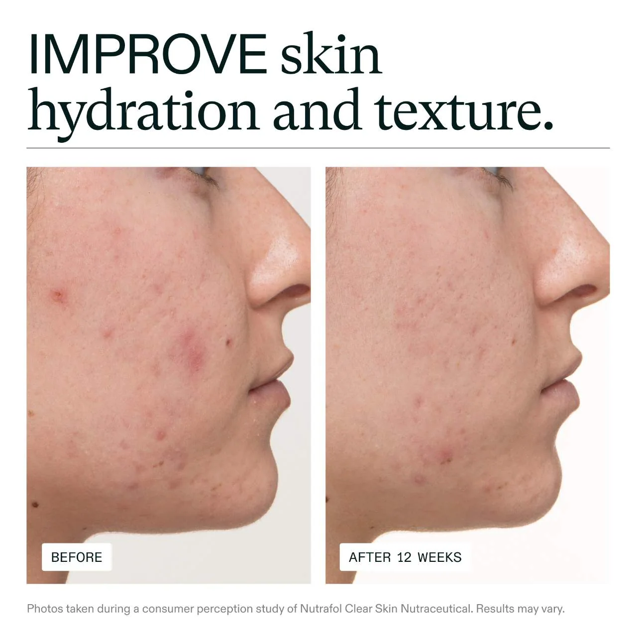 Clear Skin Physician-formulated Supplement for Acne and Breakouts
