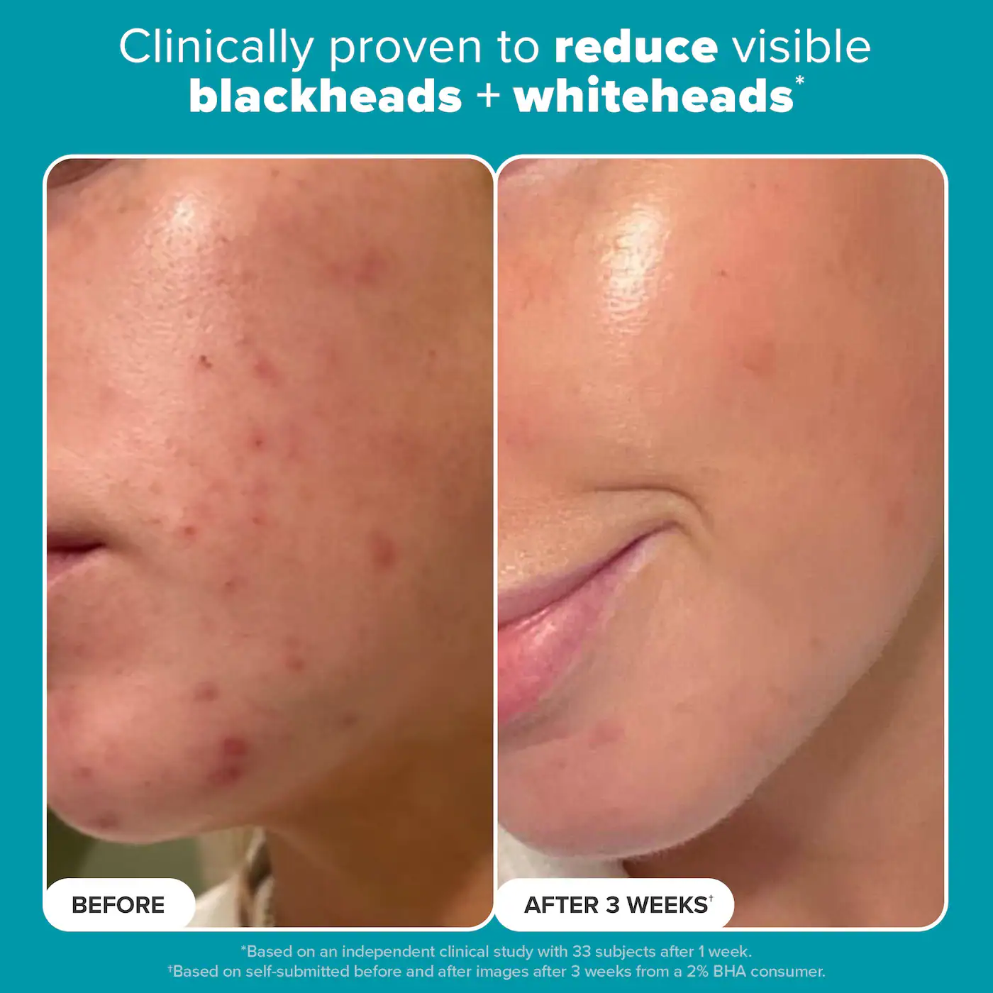 Mini Skin Perfecting 2% BHA Exfoliating Toner for Clear Skin
