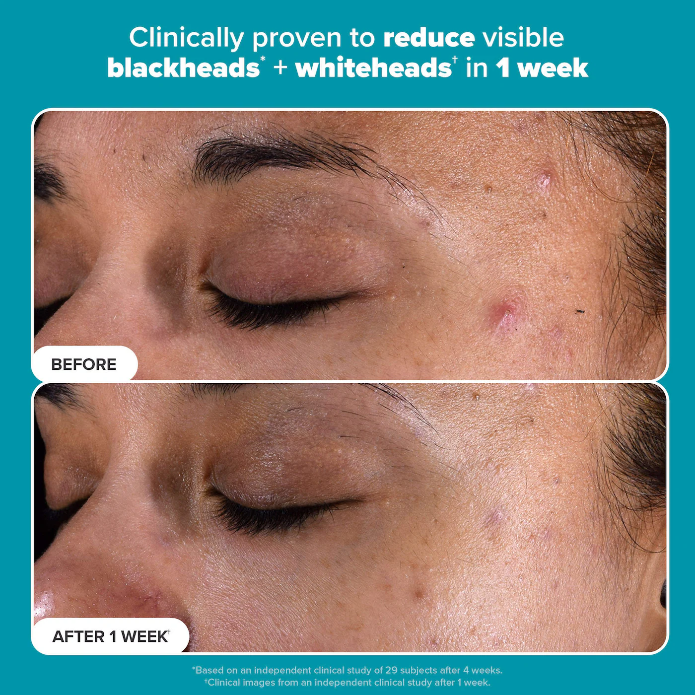 Mini Skin Perfecting 2% BHA Exfoliating Toner for Clear Skin