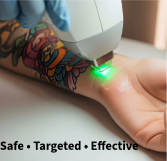 Consulttaion for Precision Ink Removal (Tattoo Removal)精准雷射除刺青疗程