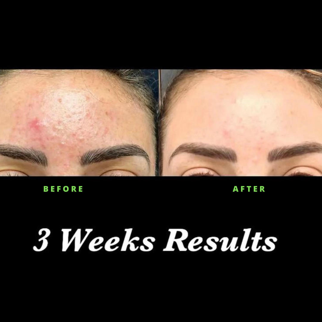 Luxskin|Advanced Acne Serum