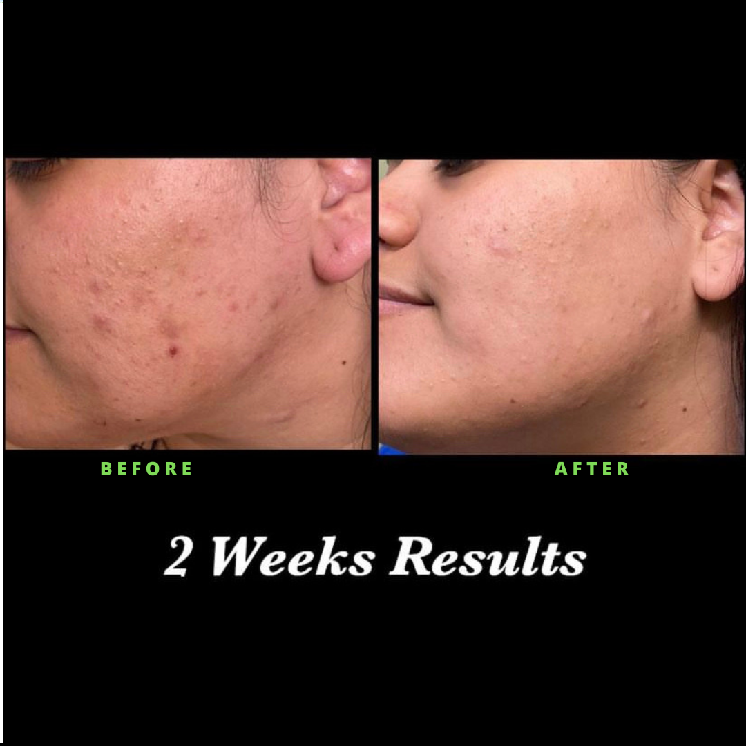 Luxskin|Advanced Acne Serum