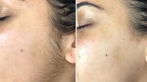 Revitaliza Tu Piel con Nuestro Exclusivo Servicio de Dermaplaning