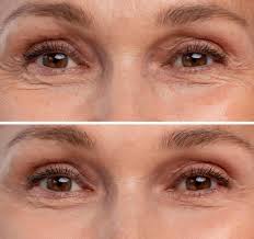 ¡Transforma tu piel con el tratamiento Exosomas!
