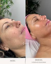 ¡Transforma tu piel con el tratamiento Exosomas!