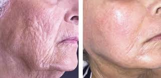 ¡Transforma tu piel con el tratamiento Exosomas!