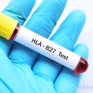 HLA-B27 Test