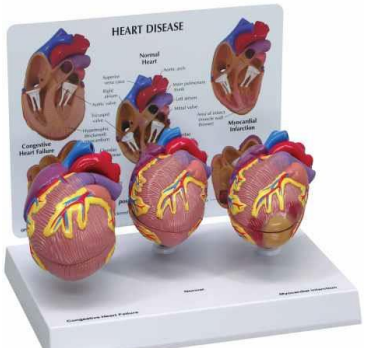 HEART DISEASE Set of 3d Model