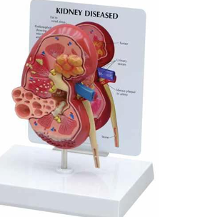 KIDNEY DISEASED 