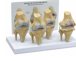 STAGES OF  OSTEOARTHRITIS 