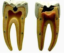 DENTAL CARIES MODEL