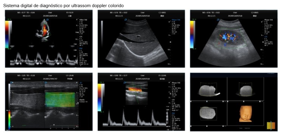 Ultrassom Portátil US60 TURBO Doppler Colorido