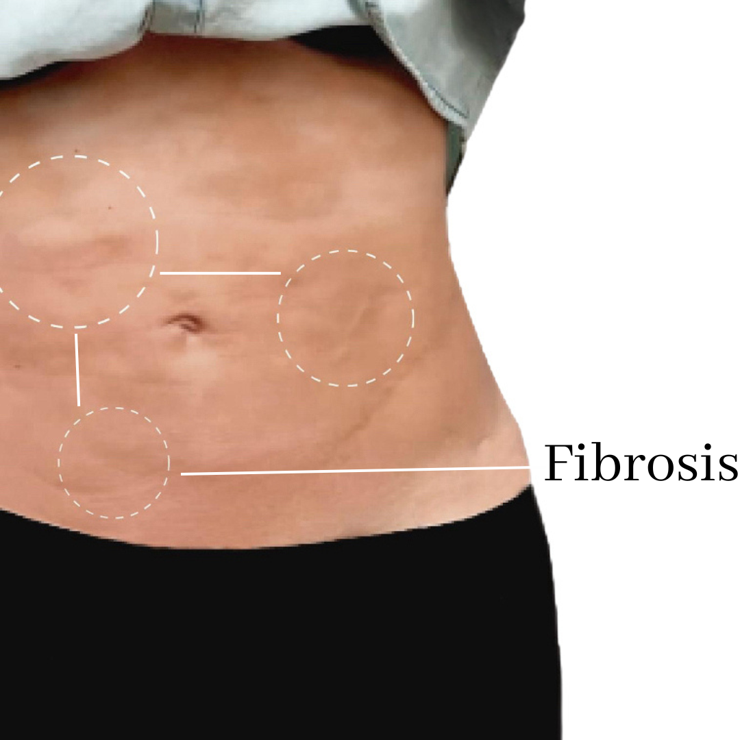 Plan Fibrosis Zero