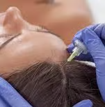 Carboxiterapia Alopecia 